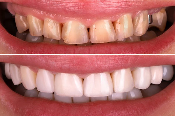 Are There Popular Smile Makeover Options?